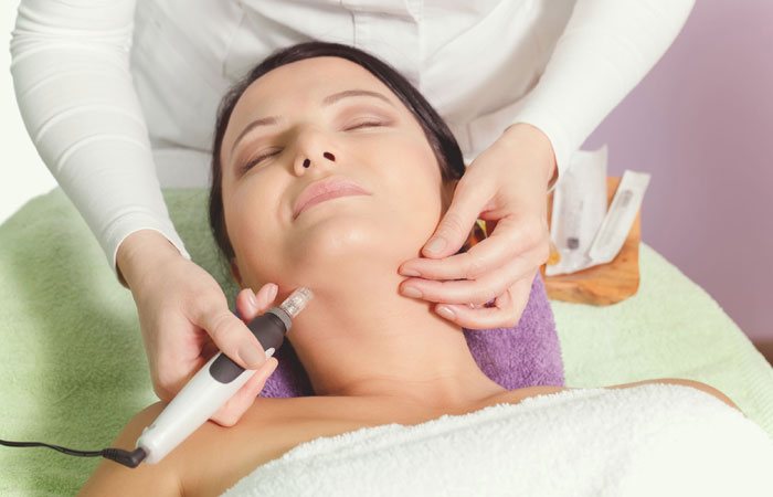 SKIN NEEDLING